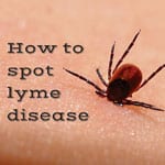 Lyme Disease Symptoms Could Be Mistaken For Covid-19, With Serious Consequences