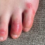 ‘COVID Toes,’ Other Rashes Latest Possible Rare Virus Signs